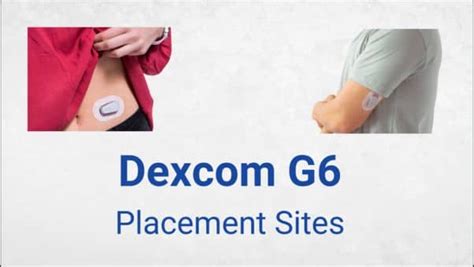 You should be fine. . Best place to put dexcom g6
